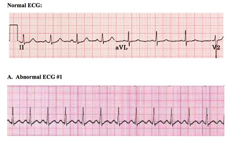 normal ecg report|normal ekg reading vs abnormal.
